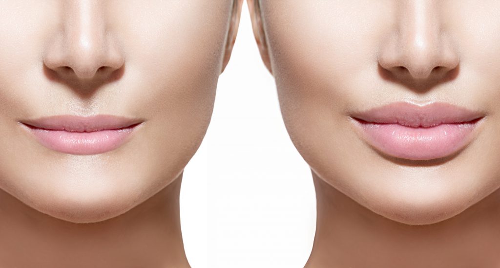 injections dacide hyaluronique fillers