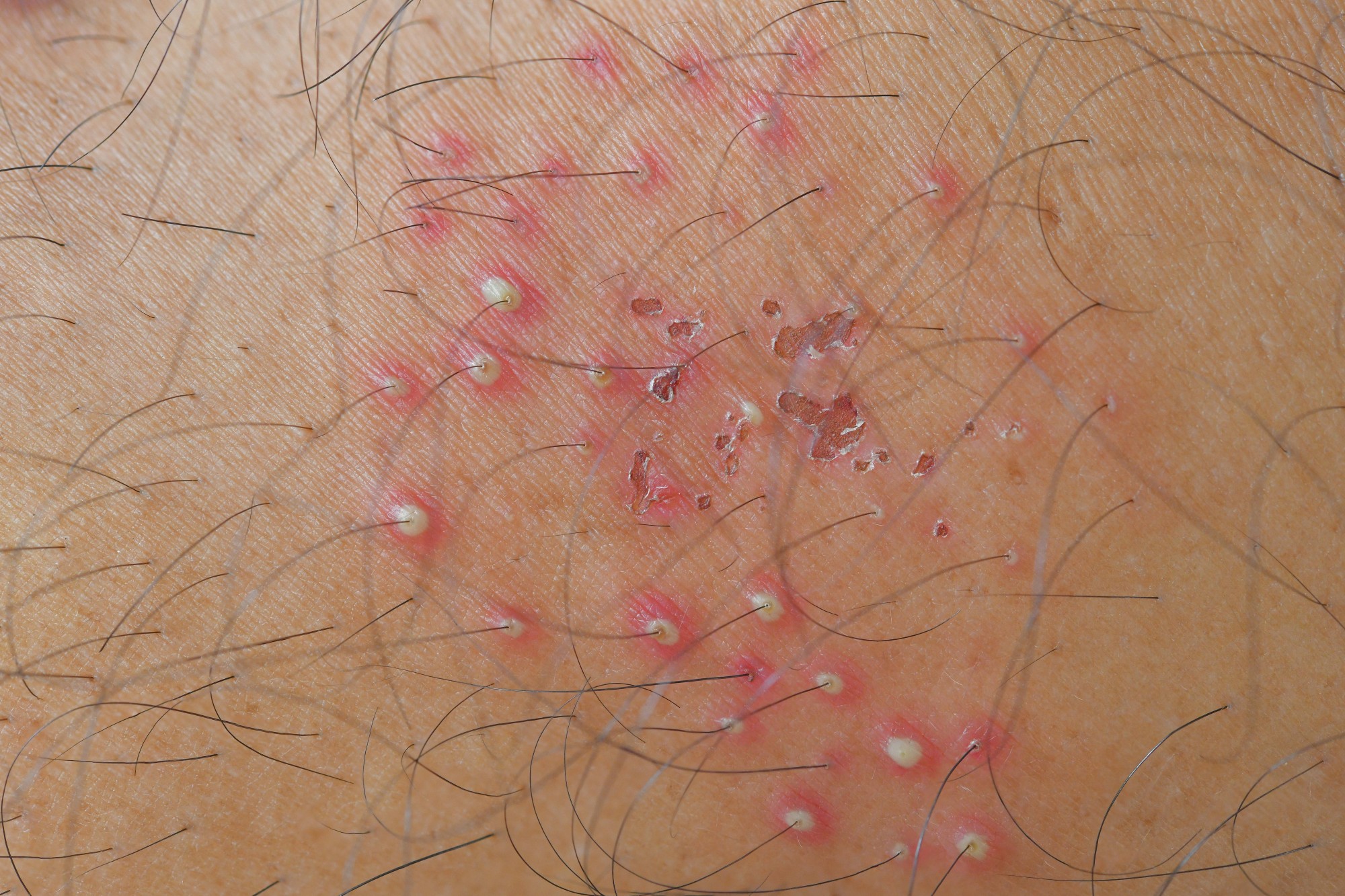 Folliculitis haarwortelontsteking behandelbaar met laserontharing
