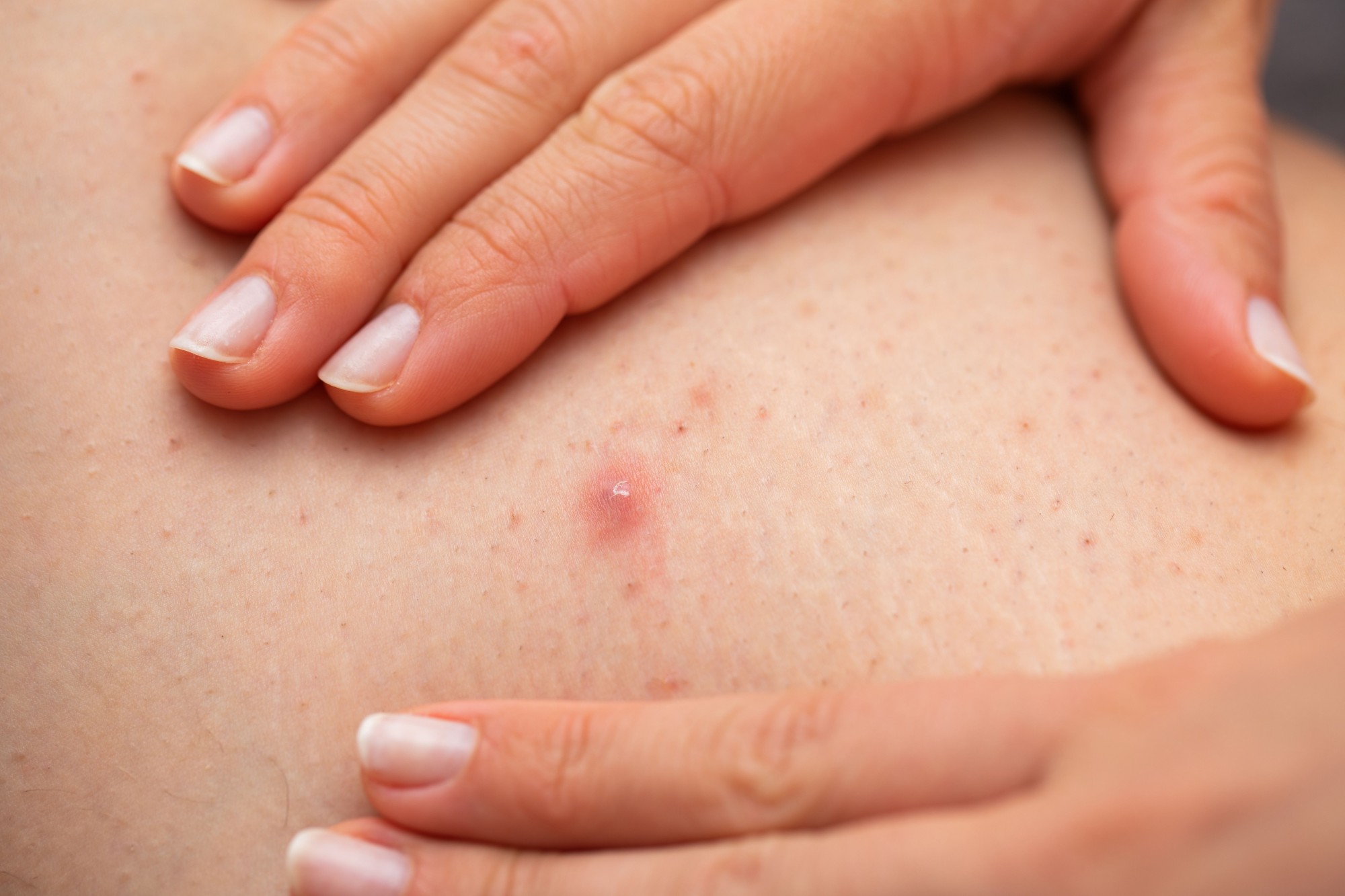 Huidirritatie door scheren of waxen voor laserontharing