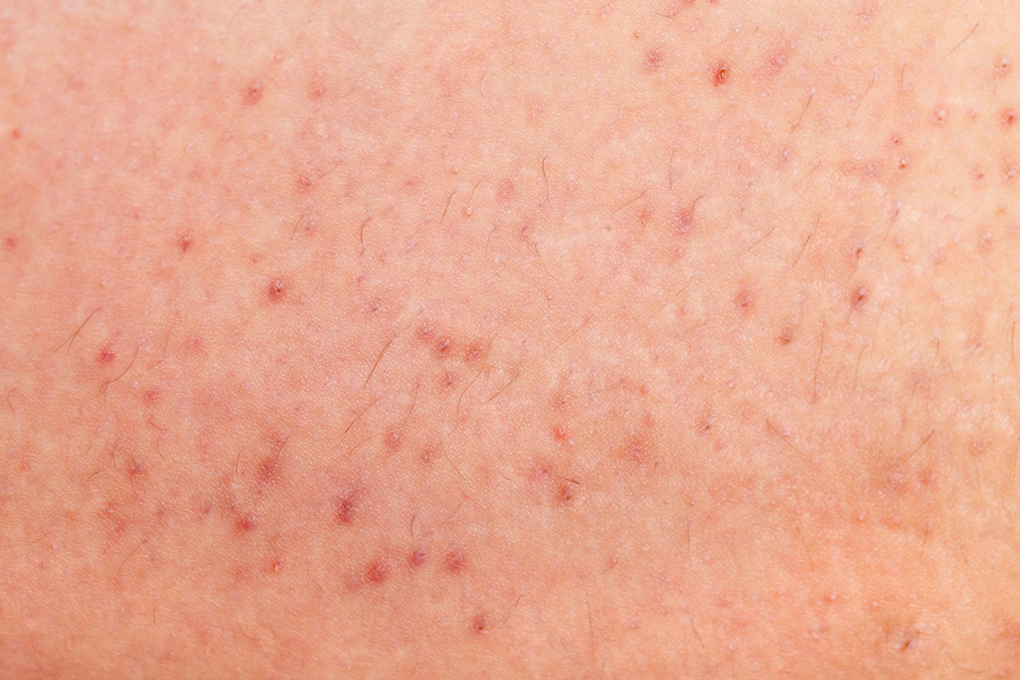 Ingrown hairs and irritation solved by laser treatment I Care Clinic