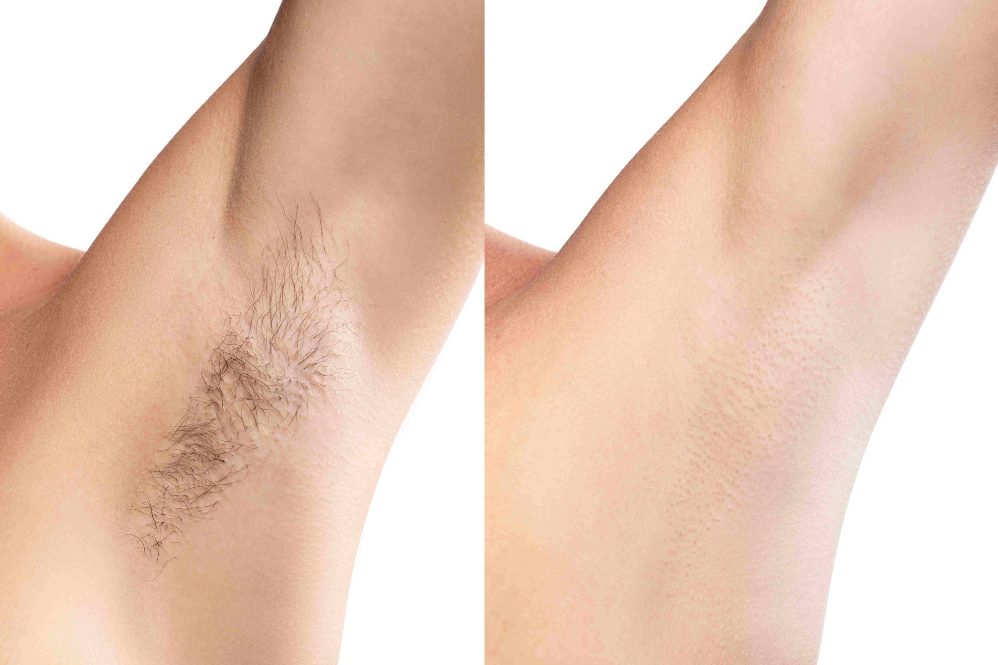 Body laser hair removal