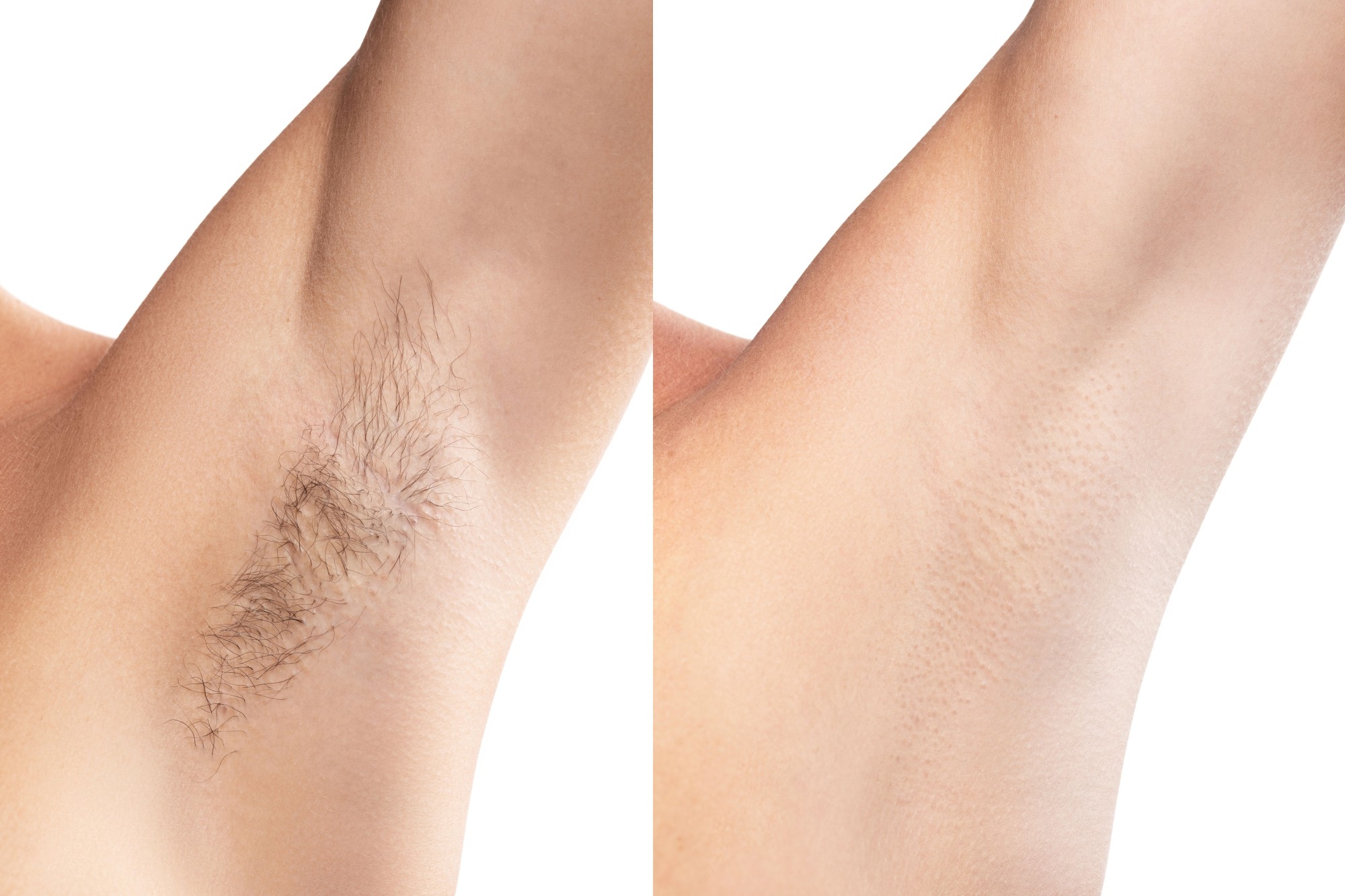 Are you looking for the best laser for laser hair removal in Belgium?